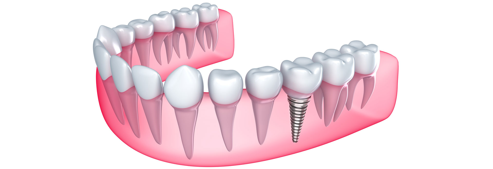 Dental implant in the gum