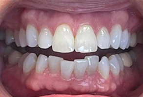 Nancy - Invisalign Treatment Before & After Results - Before Image