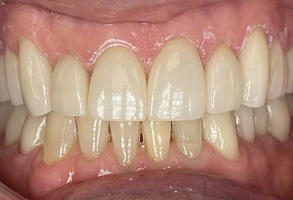 Retracted Anterior Before & After Results After Image - Shandley Kane Dental