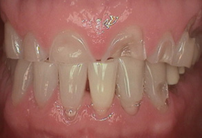 Retracted Anterior Before & After Results Before Image - Shandley Kane Dental