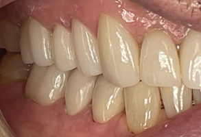 Right Side Retracted Before and After Results After Image - Shandley Kane Dental