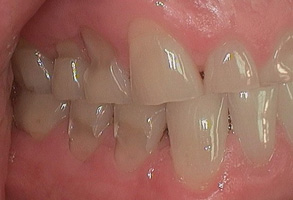 Right Side Retracted Before and After Results Before Image - Shandley Kane Dental