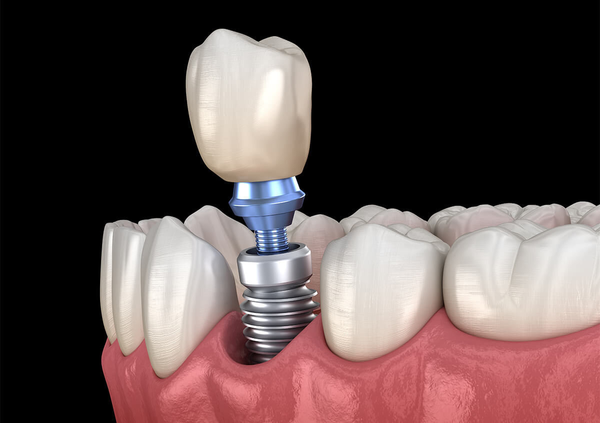 Dental Implant Procedure in Hoffman Estates IL Area